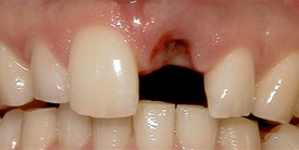 close-up of patient's teeth with one missing